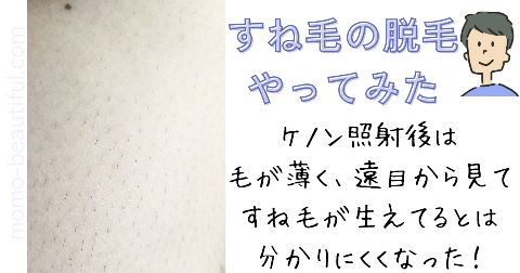 ケノン男性のすね毛の脱毛経過(5か月目)