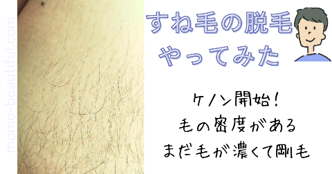 ケノン男性のすね毛の脱毛経過(1か月目)